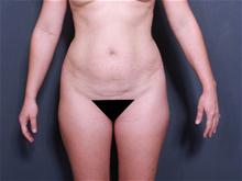 Liposuction Before Photo by Johan Brahme, MD; La Jolla, CA - Case 27794