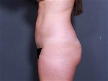 Liposuction After Photo by Johan Brahme, MD; La Jolla, CA - Case 27794