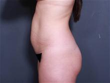 Liposuction Before Photo by Johan Brahme, MD; La Jolla, CA - Case 27794