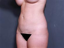 Liposuction After Photo by Johan Brahme, MD; La Jolla, CA - Case 27794