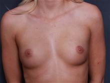 Breast Augmentation Before Photo by Johan Brahme, MD; La Jolla, CA - Case 27796