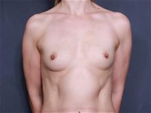 Breast Augmentation Before Photo by Johan Brahme, MD; La Jolla, CA - Case 27798