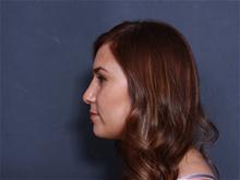 Rhinoplasty After Photo by Johan Brahme, MD; La Jolla, CA - Case 27800