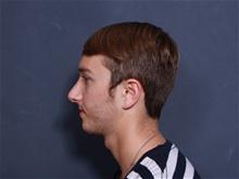 Rhinoplasty After Photo by Johan Brahme, MD; La Jolla, CA - Case 27801