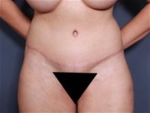 Tummy Tuck After Photo by Johan Brahme, MD; La Jolla, CA - Case 27835