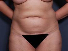 Tummy Tuck Before Photo by Johan Brahme, MD; La Jolla, CA - Case 27835