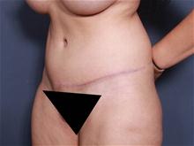 Tummy Tuck After Photo by Johan Brahme, MD; La Jolla, CA - Case 27835