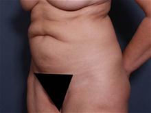 Tummy Tuck Before Photo by Johan Brahme, MD; La Jolla, CA - Case 27835