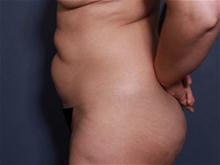 Tummy Tuck Before Photo by Johan Brahme, MD; La Jolla, CA - Case 27835