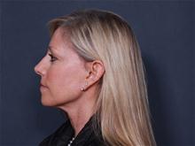 Facelift After Photo by Johan Brahme, MD; La Jolla, CA - Case 27837