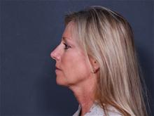 Facelift Before Photo by Johan Brahme, MD; La Jolla, CA - Case 27837