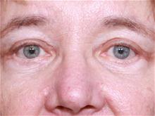 Eyelid Surgery After Photo by Johan Brahme, MD; La Jolla, CA - Case 28050