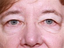 Eyelid Surgery Before Photo by Johan Brahme, MD; La Jolla, CA - Case 28050