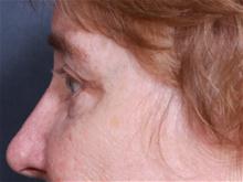 Eyelid Surgery After Photo by Johan Brahme, MD; La Jolla, CA - Case 28050