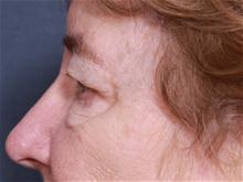 Eyelid Surgery Before Photo by Johan Brahme, MD; La Jolla, CA - Case 28050