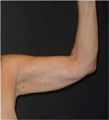 Arm Lift Before Photo by Jeff Angobaldo, MD; Plano, TX - Case 35240
