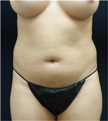 Liposuction Before Photo by Jeff Angobaldo, MD; Plano, TX - Case 35241