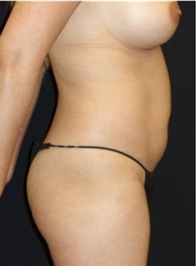 Liposuction Before Photo by Jeff Angobaldo, MD; Plano, TX - Case 35241