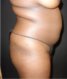 Liposuction Before Photo by Jeff Angobaldo, MD; Plano, TX - Case 35251