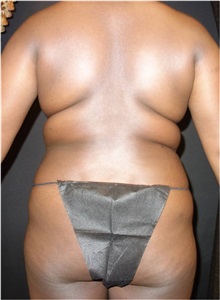 Liposuction Before Photo by Jeff Angobaldo, MD; Plano, TX - Case 35251