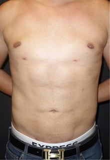 Liposuction After Photo by Jeff Angobaldo, MD; Plano, TX - Case 35253