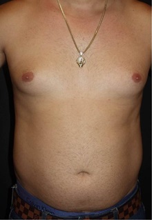 Liposuction Before Photo by Jeff Angobaldo, MD; Plano, TX - Case 35253