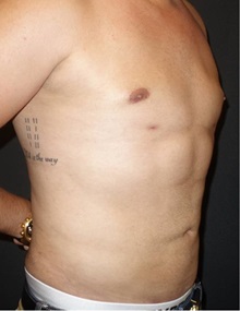 Liposuction After Photo by Jeff Angobaldo, MD; Plano, TX - Case 35253