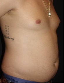 Liposuction Before Photo by Jeff Angobaldo, MD; Plano, TX - Case 35253