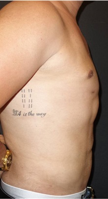 Liposuction After Photo by Jeff Angobaldo, MD; Plano, TX - Case 35253