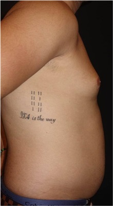 Liposuction Before Photo by Jeff Angobaldo, MD; Plano, TX - Case 35253