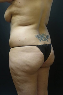 Liposuction Before Photo by Jeff Angobaldo, MD; Plano, TX - Case 35254
