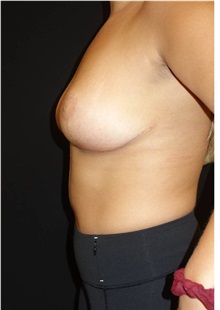 Breast Reduction After Photo by Jeff Angobaldo, MD; Plano, TX - Case 35260