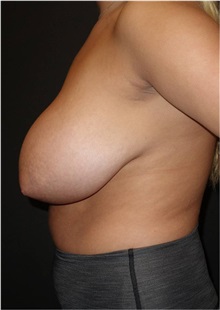 Breast Reduction Before Photo by Jeff Angobaldo, MD; Plano, TX - Case 35260