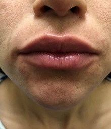 Lip Augmentation/Enhancement After Photo by Jeff Angobaldo, MD; Plano, TX - Case 35261
