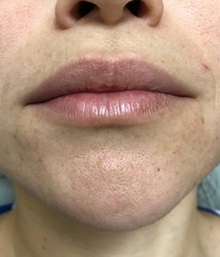 Lip Augmentation/Enhancement Before Photo by Jeff Angobaldo, MD; Plano, TX - Case 35261