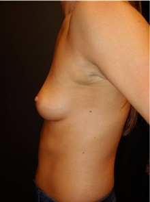 Breast Augmentation Before Photo by Jeff Angobaldo, MD; Plano, TX - Case 35285