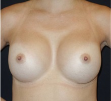 Breast Augmentation After Photo by Jeff Angobaldo, MD; Plano, TX - Case 35286
