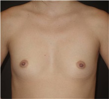 Breast Augmentation Before Photo by Jeff Angobaldo, MD; Plano, TX - Case 35286