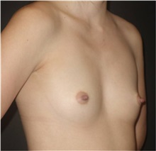 Breast Augmentation Before Photo by Jeff Angobaldo, MD; Plano, TX - Case 35286