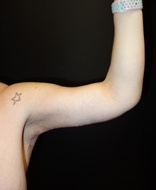 Arm Lift After Photo by Jeff Angobaldo, MD; Plano, TX - Case 35492