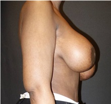 Breast Lift Before Photo by Jeff Angobaldo, MD; Plano, TX - Case 35495