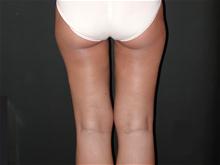 Liposuction After Photo by Robert Kure, MD, PhD; Tokyo,  - Case 27862