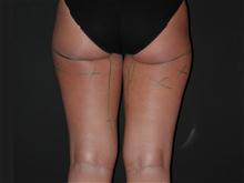 Liposuction Before Photo by Robert Kure, MD, PhD; Tokyo,  - Case 27862