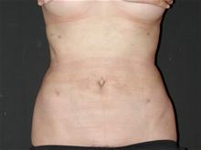 Liposuction After Photo by Robert Kure, MD, PhD; Tokyo,  - Case 27873
