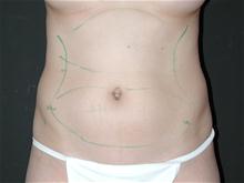 Liposuction Before Photo by Robert Kure, MD, PhD; Tokyo,  - Case 27873