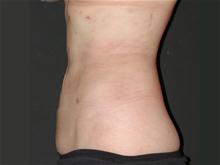 Liposuction After Photo by Robert Kure, MD, PhD; Tokyo,  - Case 27873