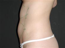 Liposuction Before Photo by Robert Kure, MD, PhD; Tokyo,  - Case 27873