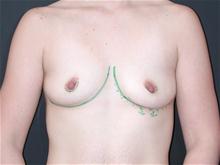 Breast Augmentation Before Photo by Robert Kure, MD, PhD; Tokyo,  - Case 27875