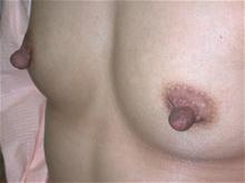 Breast Reconstruction Before Photo by Robert Kure, MD, PhD; Tokyo,  - Case 27876