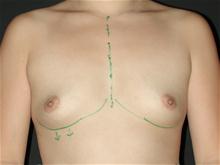 Breast Augmentation Before Photo by Robert Kure, MD, PhD; Tokyo,  - Case 27877